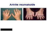 Artrite reumatoide. Malattia infiammatoria cronica sistemica caratterizzata da una elettiva localizzazione poliarticolare, ad andamento progressivo, con.