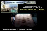 FISTOLA ANASTOMOTICA IN CHIRURGIA COLORETTALE IL TRATTAMENTO DELLA FISTOLA Baldassarre Sansoni – Ospedale di Frosinone.