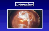 LAterosclerosi. Aterosclerosi : è una patologia delle arterie di medio e grosso calibro (muscolari ed elastiche) con prograssivo accumulo nella (muscolari.