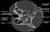 Anatomia Rocca TC - CT temporal bone anatomy