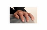 Artrite mani, artrite cervicale, artrite gottosa acuta, artrite idiopatica infantile