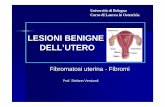 LESIONI BENIGNE DELL ’UTERO - campus.unibo.itcampus.unibo.it/133790/25/5) Fibromi.pdf · Fibromatosi uterina -Fibromi ... presenza di uno o più noduli di ... • Il ruolo dei fibromi