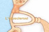 L’otosclerosi - unife.it · Cenni storici Nel 1715 Valsalva osservò per la prima volta un caso di otosclerosi su cadavere: il grande anatomico non indagò tuttavia la natura del