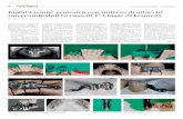 Riabilitazione protesica con utilizzo di attacchi ... · Fabrizio Coppola, Laboratorio Odontoservice snc, Bologna Paziente portatrice di protesi fissa superiore e protesi combinata