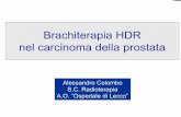 Brachiterapia HDR nel carcinoma della prostatavecchiosito.istitutotumori.mi.it/istituto/documenti/attivita/... · La brachiterapia è una forma di radioterapia effettuata mediante