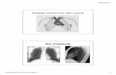 Esame obiettivo del cuore [modalità compatibilità] obiettivo del cuore 2011.pdf · 2017-01-11 · RUMORI AGGIUNTI IN DIASTOLE T4 T1 T2 T1 3. GALOPPO ATRIALE (T4) Precede S1, bassa