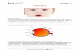 Oculistica - associazioneinnovitae.it · L’astigmatismo si verifica quando la superficie interiore dell’occhio, la cornea, ha una curvatura irregolare. ... Cataratta pediatrica