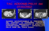 TAC ADDOME-PELVI del 07/03/2002 - Giuseppe Di Bella · spleniche invariate. in sede . pelvica anse intestinali adese tra loro e alla . parete addominale anteriore.