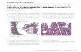Viene de la página 271 - Revista ACTAViene de la página 271 u IMAGEN DEL NÚMERO La anatomía patológica mostró una mucosa duode-nal en transición a luces glandulares con revestimiento