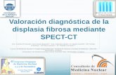 Valoración diagnóstica de la displasia fibrosa mediante ... · Las imágenes de SPECT/CT permiten un diagnóstico etiológico más preciso de la displasia fibrosa al correlacionar