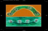 Rivista Internazionale di Parodontologia & Odontoiatria Ricostruttiva · 2017. 10. 24. · “ ( DF2, Dental Konos ) fu incollata sul-la superficie distale di ognuno dei pi-lastri