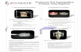 3. Marcação com Guta-Percha 4. Registro Tomográfico ...fenelon.com.br/.../2016/06/Protocolo_Pre_Tomografia...tomografia computadorizada. As perfurações devem ser realizadas por