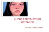 LES Lupus eritematoso sistemico